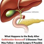 What happens to your body after gallbladder is removed