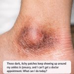 These dark, itchy patches keep showing up around my ankles in January, and I can’t get a doctor appointment. What can I do today?