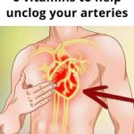 6 vitamins that can help with clogged arteries