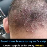 Found these bumps on my son’s scalp. Doctor appt is so far away. What’s should I do? They look really painful
