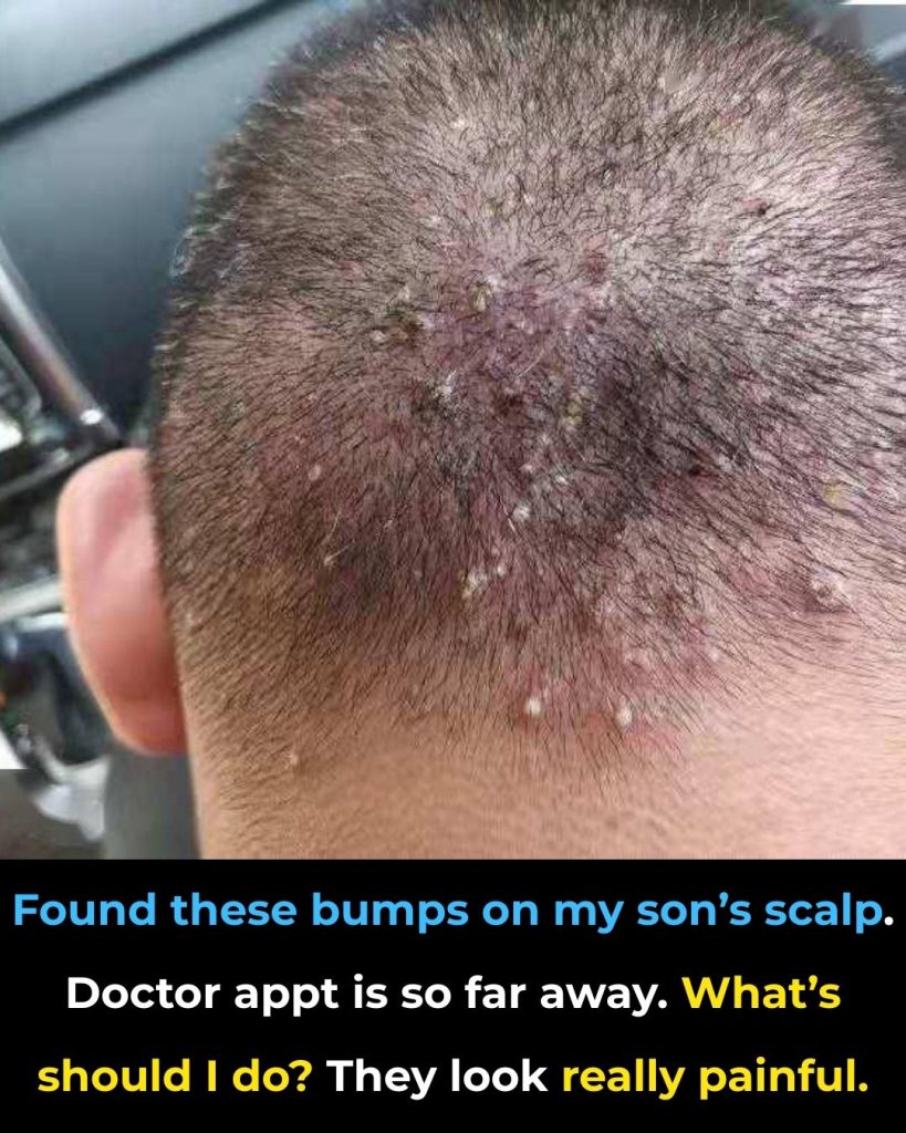 Found these bumps on my son’s scalp. Doctor appt is so far away. What’s should I do? They look really painful