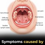 What Symptoms Does HPV Cause in the Throat?