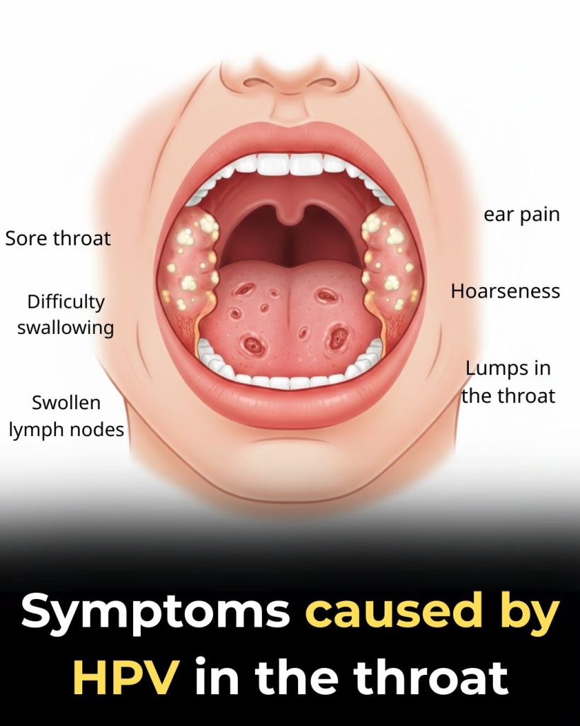 What Symptoms Does HPV Cause in the Throat?
