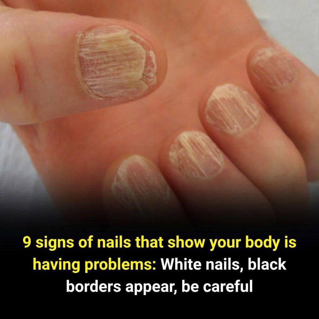 9 Alarming Nail Changes That Reveal Hidden Health Problems