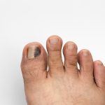 Black Toenail? What It May Indicate and What to Do Next