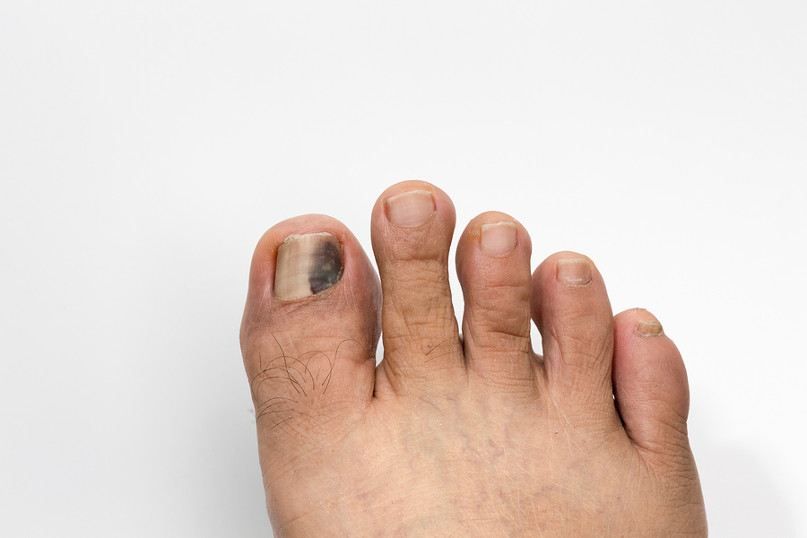 Black Toenail? What It May Indicate and What to Do Next