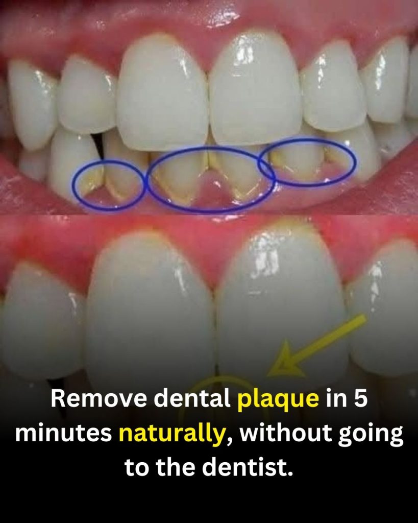How to Reduce Dental Plaque Naturally at Home
