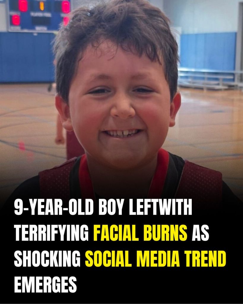 9-year-old boy left with terrifying facial burns as shocking social media trend emerges