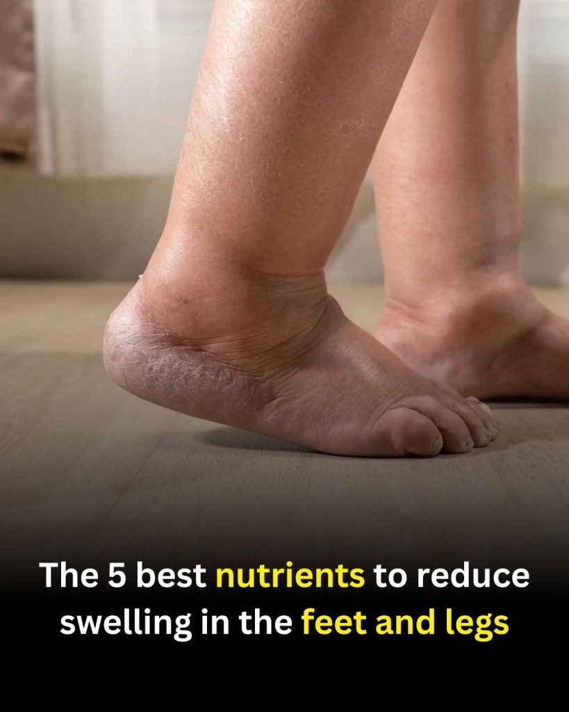 The 5 best nutrients to reduce swelling in the feet and legs