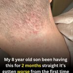 Child Experiencing Ongoing Itchy Skin? Understanding Hives (Urticaria) and When to Seek Care
