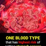 Doctors Reveal the One Blood Type Linked to the Highest Risk of Stomach Cancer