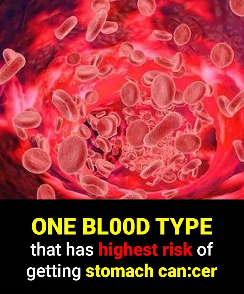 Doctors Reveal the One Blood Type Linked to the Highest Risk of Stomach Cancer