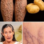 Say Goodbye to Varicose Veins and Heavy Legs with a Natural Potato Remedy