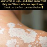 Why Do White Spots Appear on Your Skin? Hidden Causes You Shouldn’t Ignore