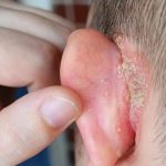My son woke up with a spot on his ear: what could it be and how can I treat it until the appointment?