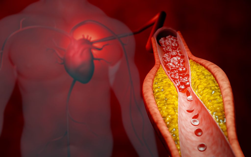 Doctor’s Recipe for Coronary Arteries: Symptoms of Coronary Artery Disease
