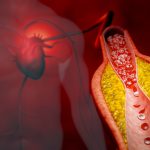 Doctor’s Recipe for Coronary Arteries: Symptoms of Coronary Artery Disease