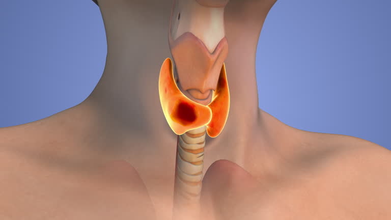 A 1-Week Diet Plan for People With Thyroid Problems in the Early Stage of Treatment