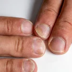 What Frequent Nail Splitting May Suggest About Your Overall Health