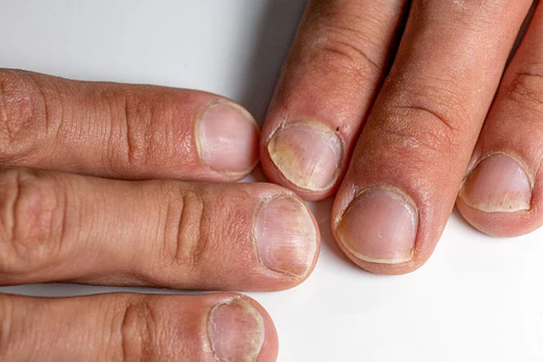 What Frequent Nail Splitting May Suggest About Your Overall Health