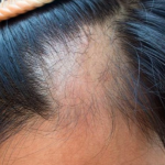 The Link Between Vitamin D and Hair Loss in Both Men and Women