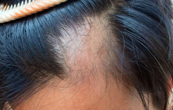 The Link Between Vitamin D and Hair Loss in Both Men and Women