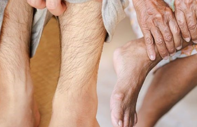 This Could Be One of the Main Visible Signs of High Cholesterol