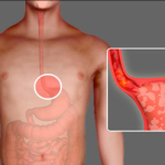 A Breakfast Food Many People Consume Daily May Be Triggering Heartburn Without Them Realizing It