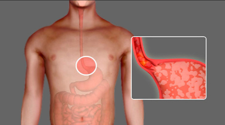 A Breakfast Food Many People Consume Daily May Be Triggering Heartburn Without Them Realizing It
