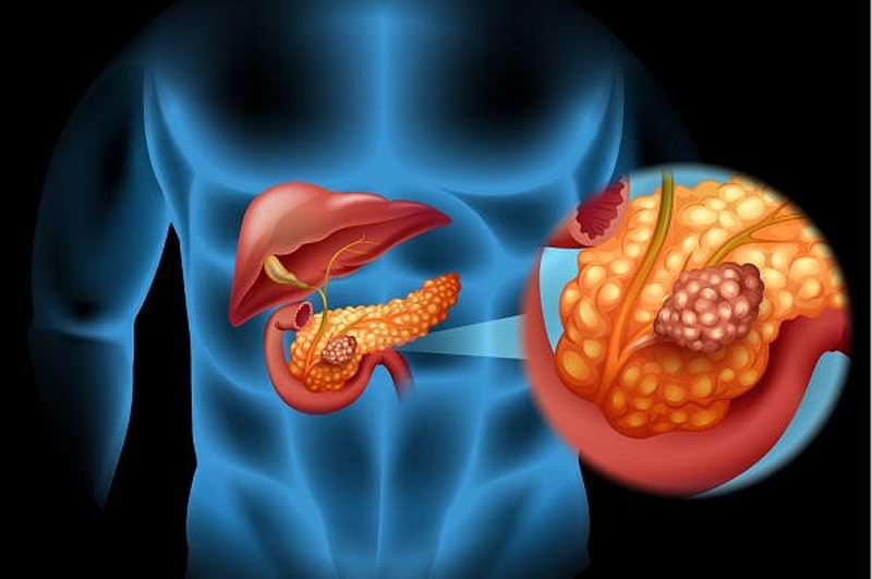 Spanish Study Brings New Hope for Pancreatic Cancer Research