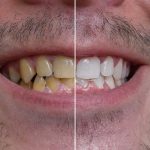 A Simple Method That May Help Reduce Yellow Stains and Plaque on Teeth